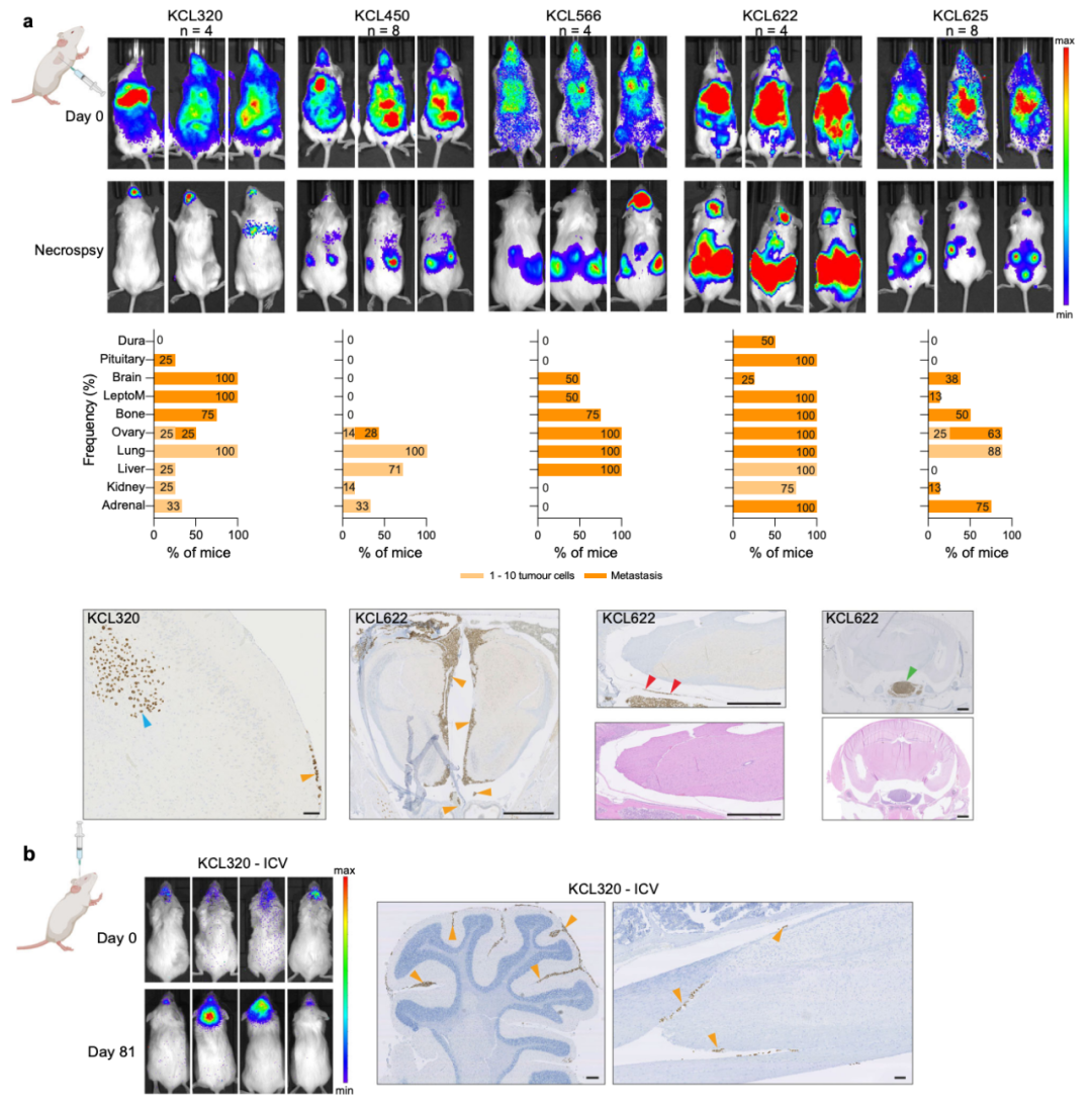 Nature子刊：患者來源的類器官，為乳腺癌腦轉移帶來新見解